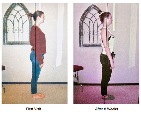 Chiropractic Issaquah WA Carly Redone Posture