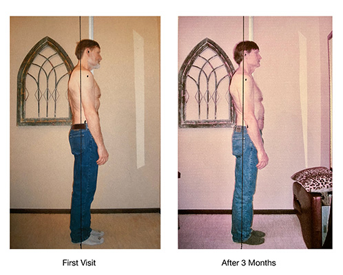 Chiropractic Issaquah WA Dale Posture