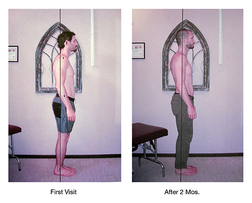 Chiropractic Issaquah WA Example Of Posture