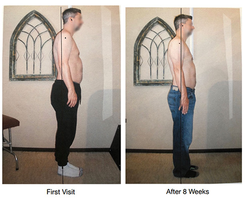 Chiropractic Issaquah WA John Pre And Post Posture