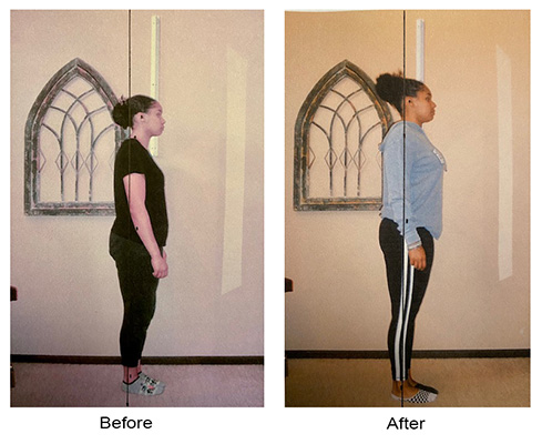Chiropractic Issaquah WA Posture Example