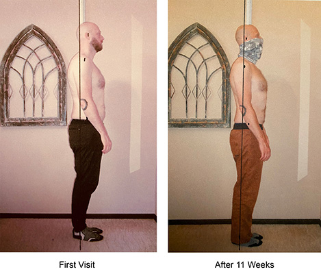 Chiropractic Issaquah WA Pre And Post Posture